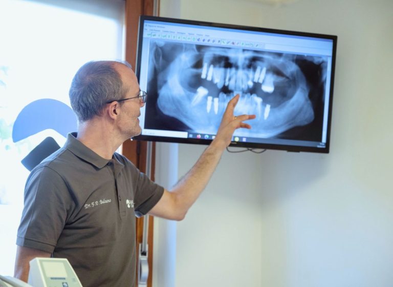 come funziona un impianto dentale
